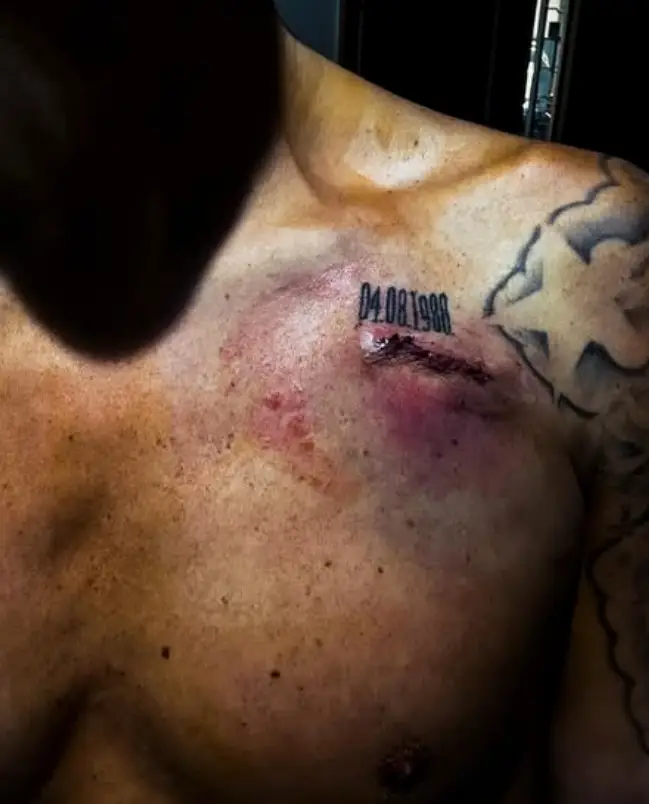 George's pacemaker scar (Instagram/@maxgeorge)