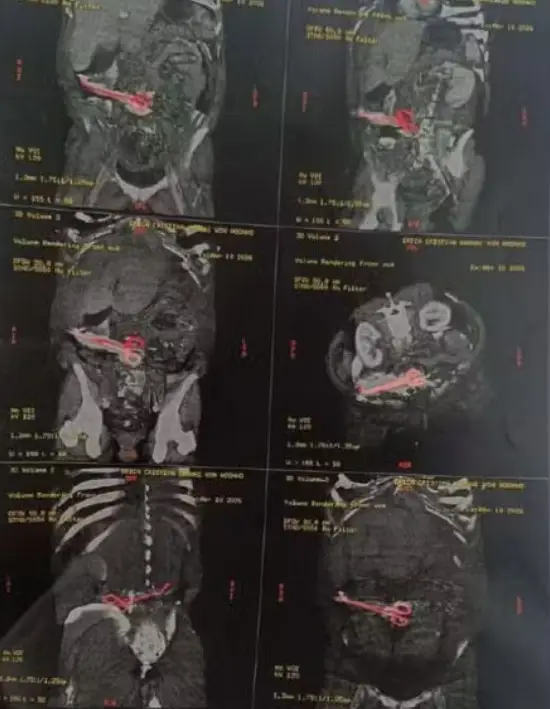 X-ray images show the forgotten 18-centimetre pair of scissors lodged inside of Erica Cristina Bannai Von Hoonholtz from a hysterectomy in January (Newsflash/NX)