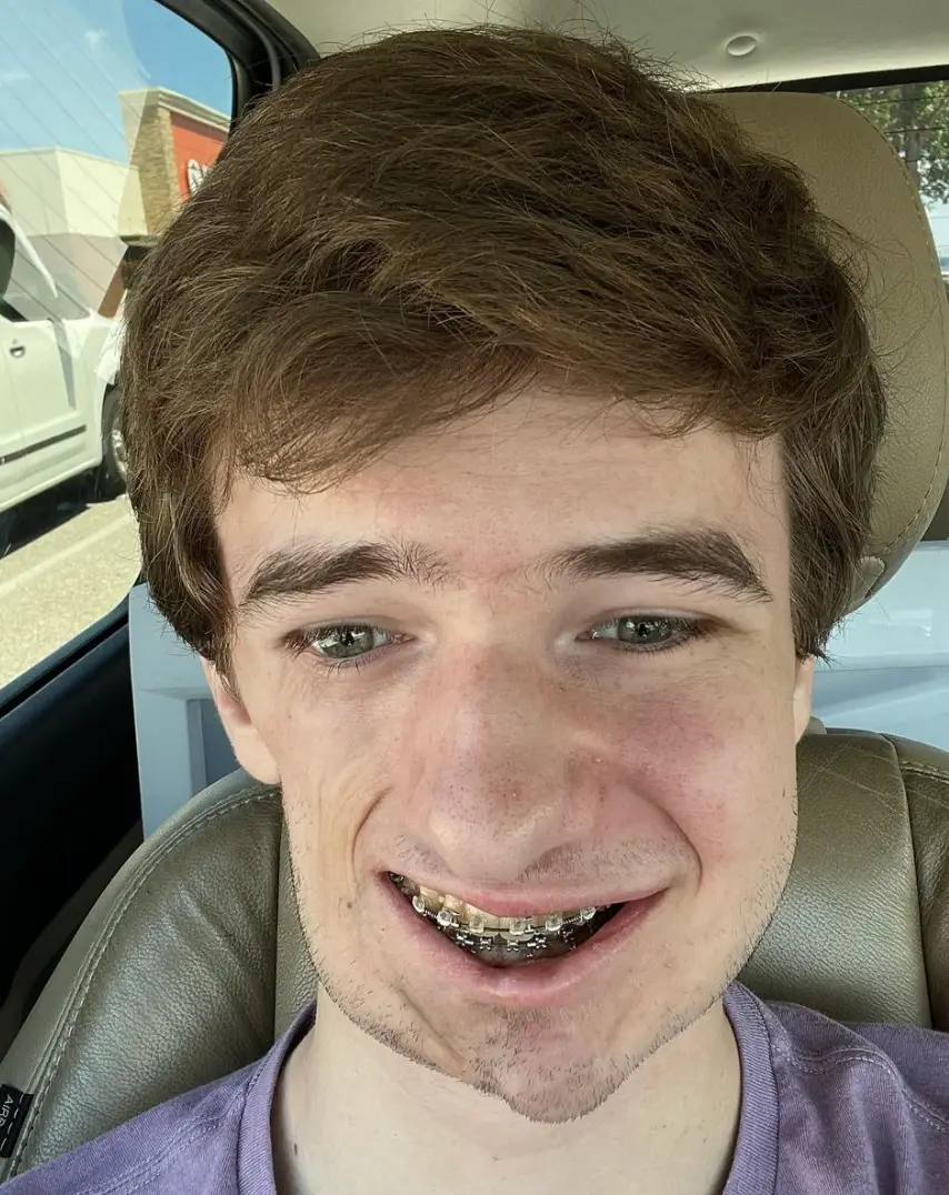 Lukas Caldwell has Parry-Romberg syndrome (Instagram/@lukas.caldwell)