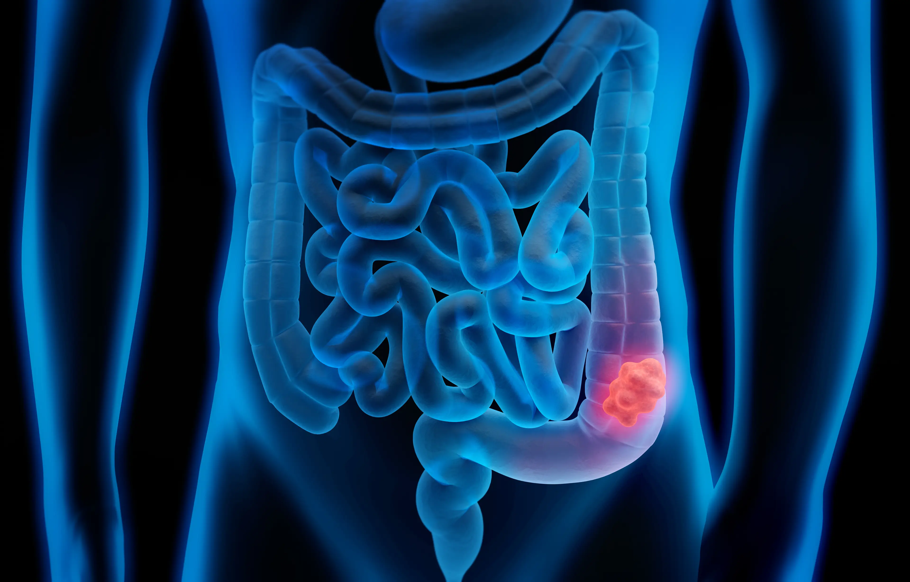 Dr Jamie Murphy explained some of the reasons that could be behind the rise in bowel cancer cases (Getty Stock Image)