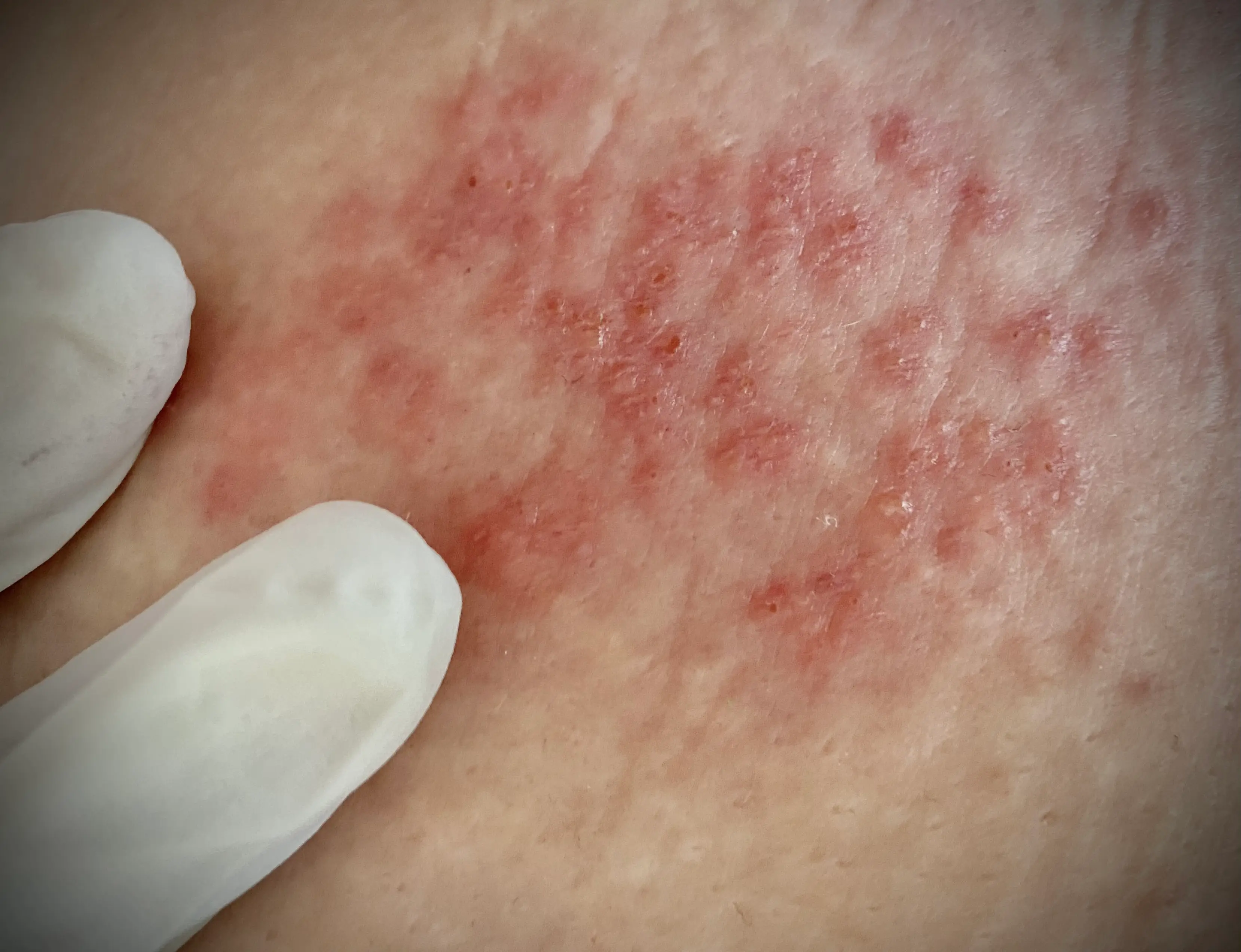 A rash caused by shingles (Getty Stock Images)