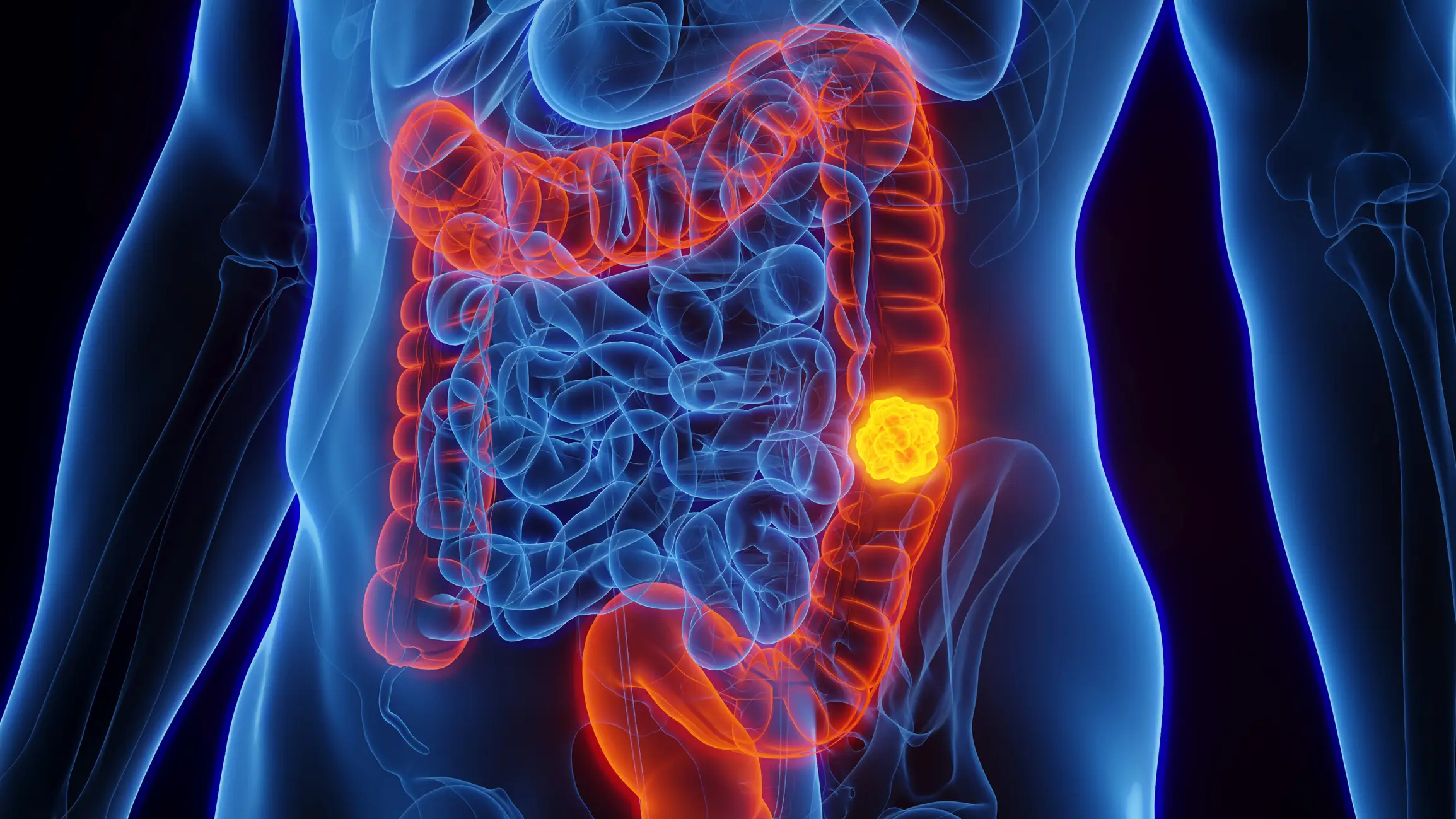 Colon cancer is one of the biggest causes of cancer deaths in the UK (Getty Stock Images)