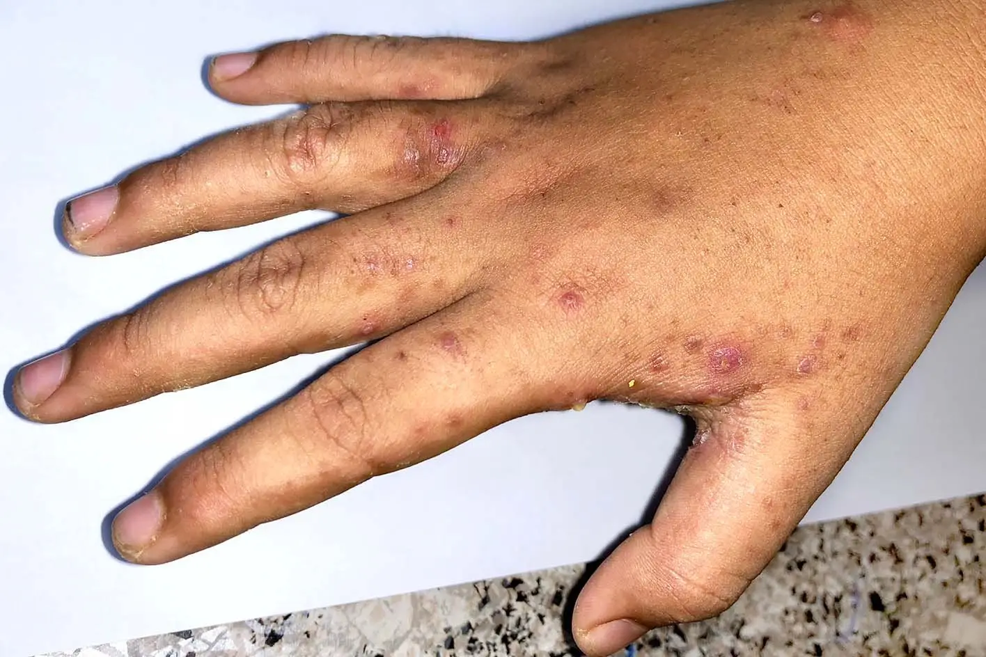 The rash is common between the fingers (NHS)