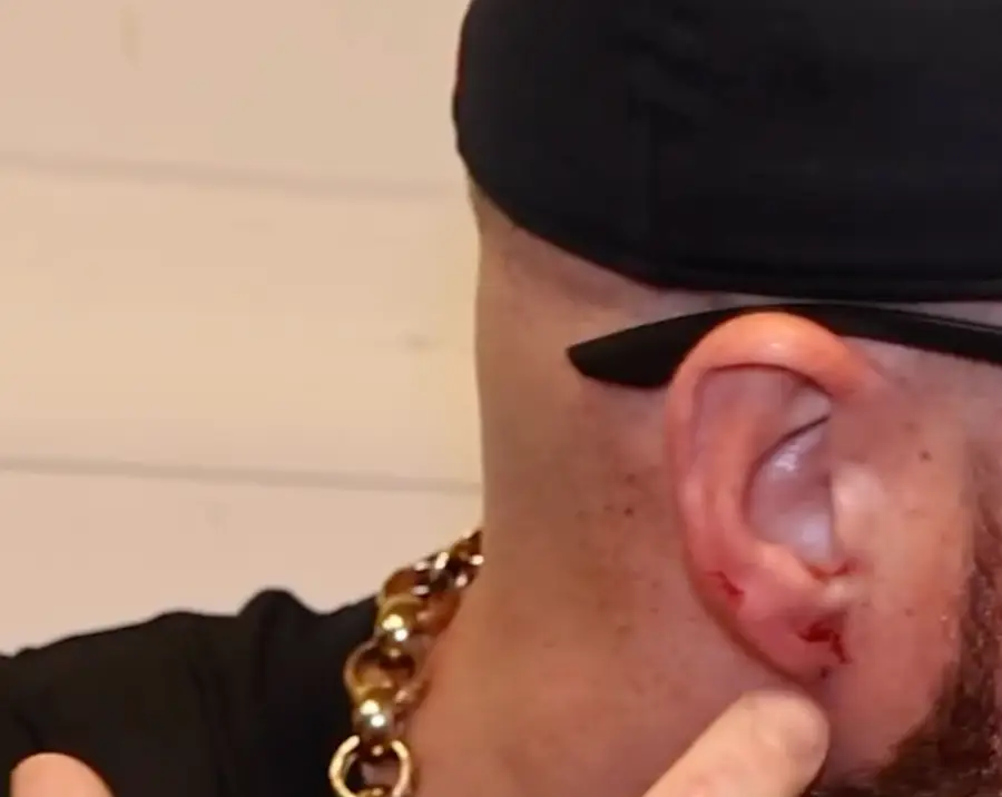 Jack Kay showed off his chomped ear (Instagram/@thestompingground)