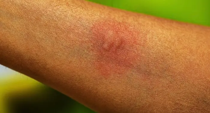 Scientists reckon they know why some people are bitten by mosquitoes more than others (Centers for Disease Control and Prevention)
