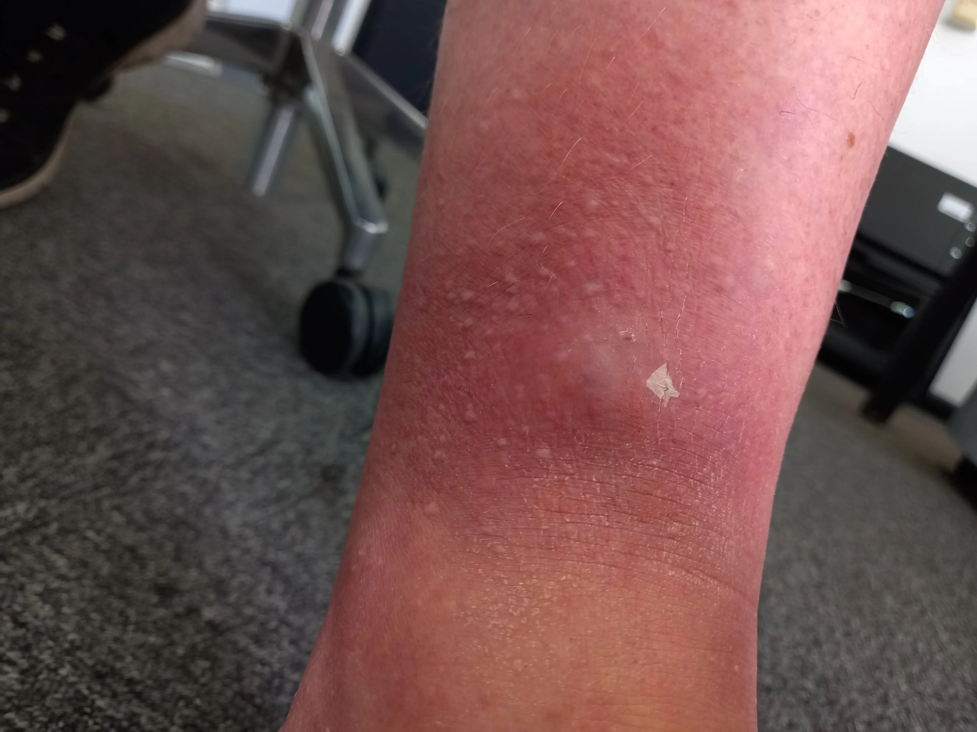 Keith Robinson got one hell of a spider bite (Pen News)