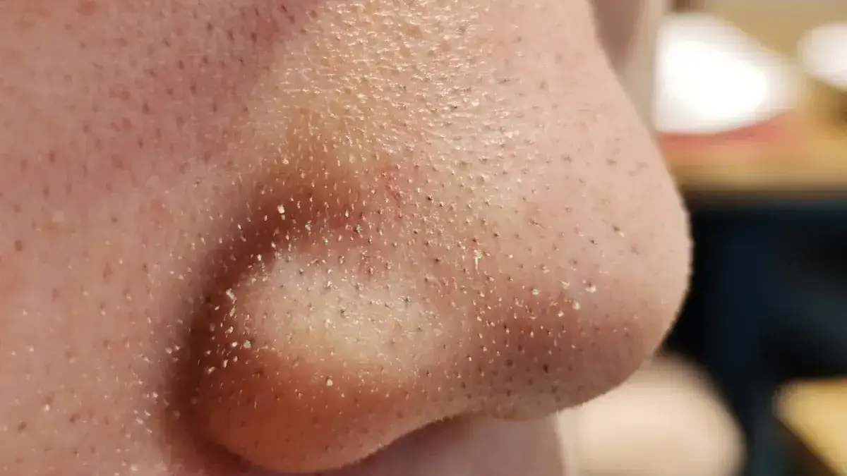 Dermatologist warns people not to squeeze black spots on nose because they're not what you think