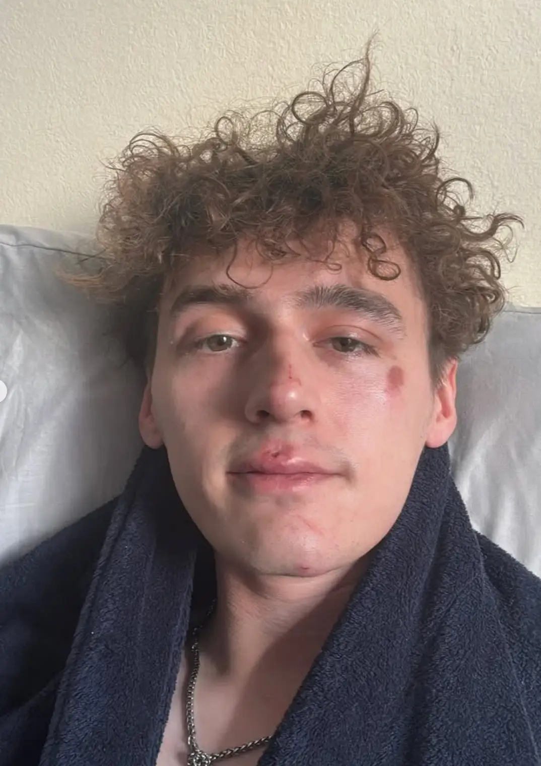 Cameron Cole showed his injuries on social media (Instagram/@ccole_99)