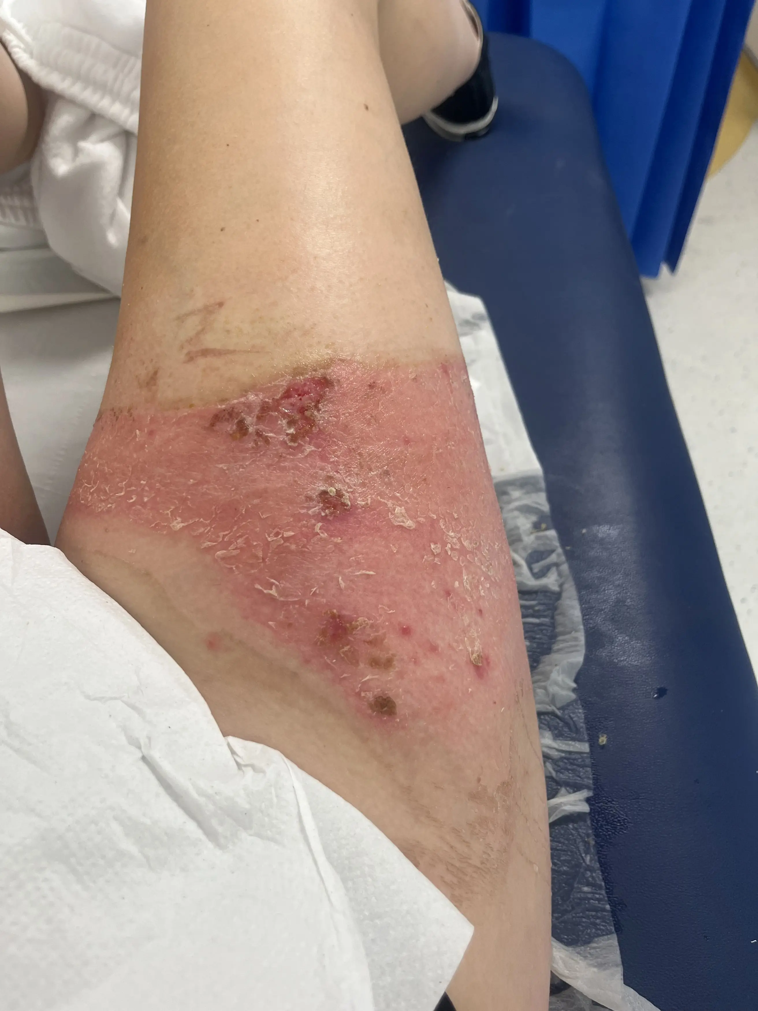 Annie's burns are beginning to heal after a hot water bottle exploded over her leg and stomach (Kennedy News and Media)