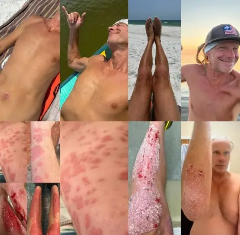 Lashbrook says his psoriasis once covered around 90 percent of his body (Instagram/carnivore_healing_retreat)