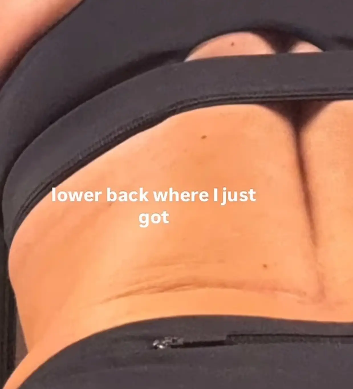 The scar on her back was photographed for social media (racheladolezal/Instagram)