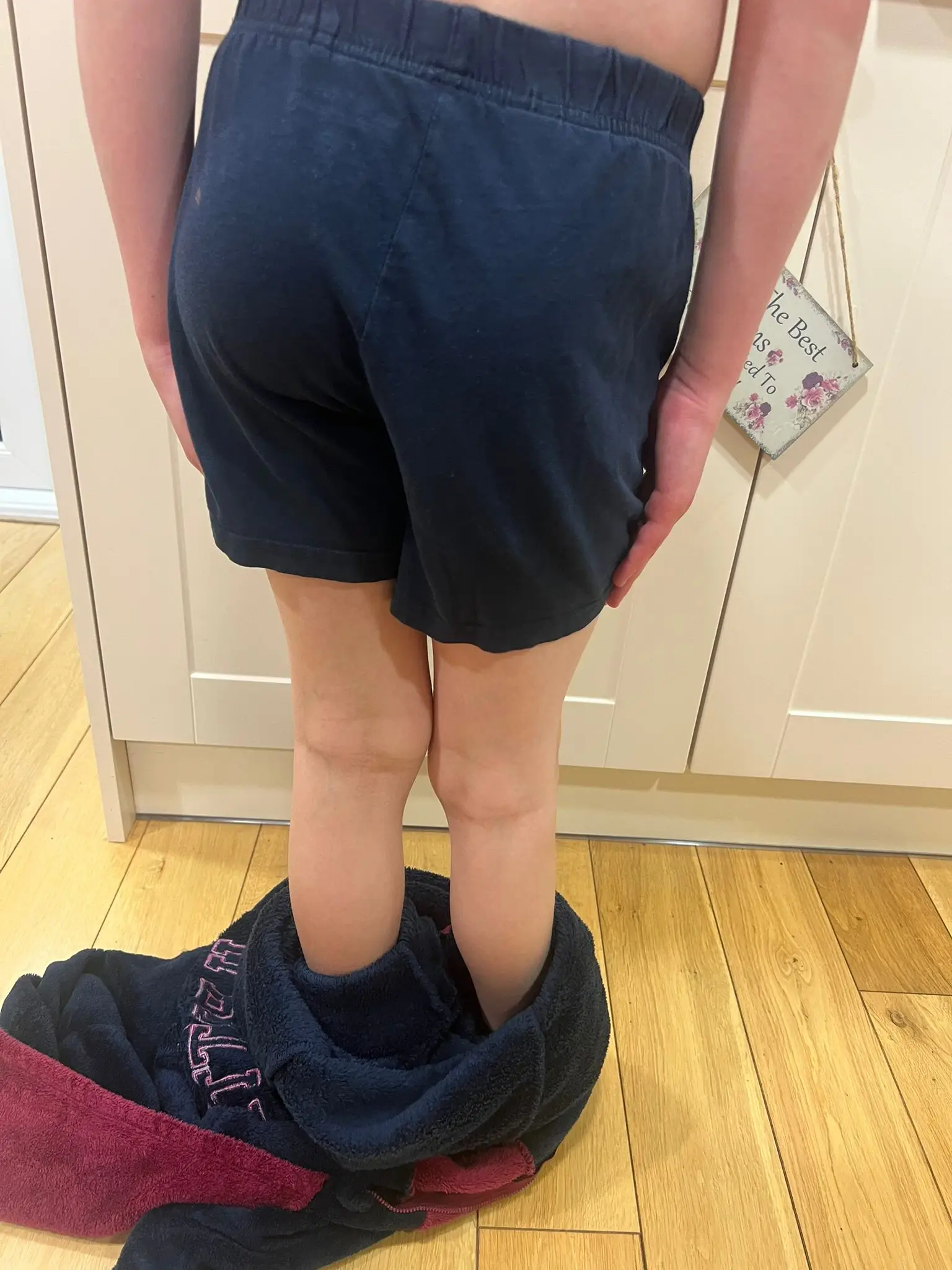 One of Alfie Phillips' legs was 4cm shorter than the other due to a condition called fibular hemimelia (Laura Ducker/PA Wire)