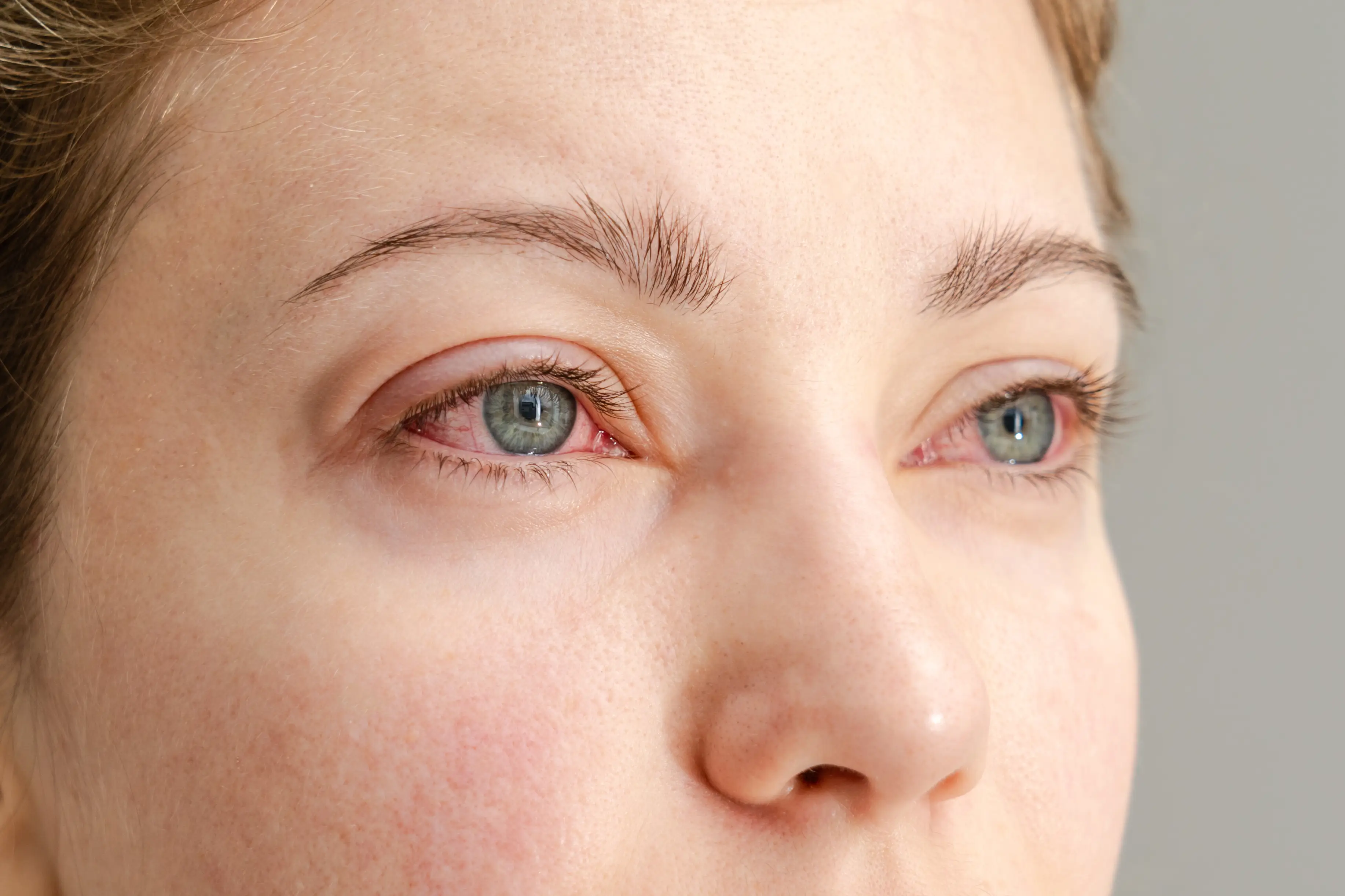 Bloodshot eyes is a telltale symptom of cannabis consumption (Getty Stock Images)