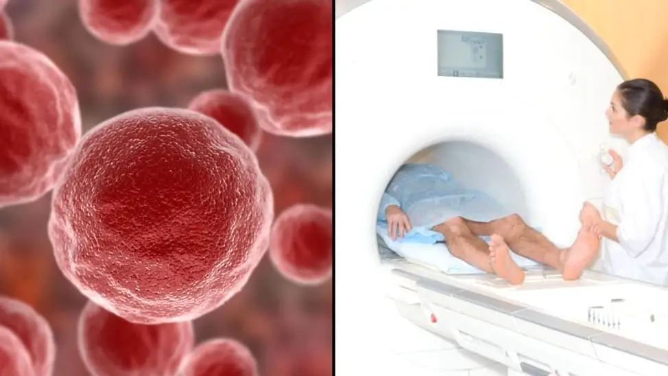 Nearly half of all cancer deaths could be prevented, study says