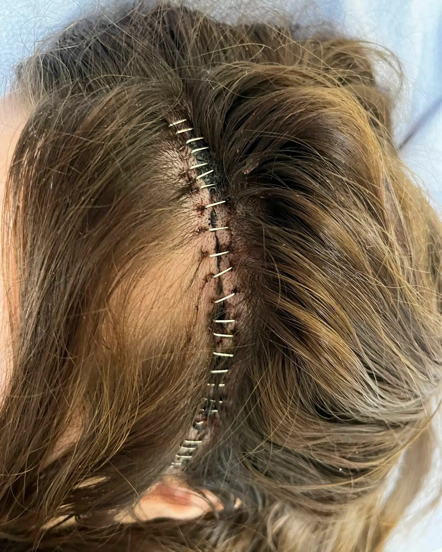 Thankfully, the brain tumour was removed during a four-hour surgery in December last year (SWNS)