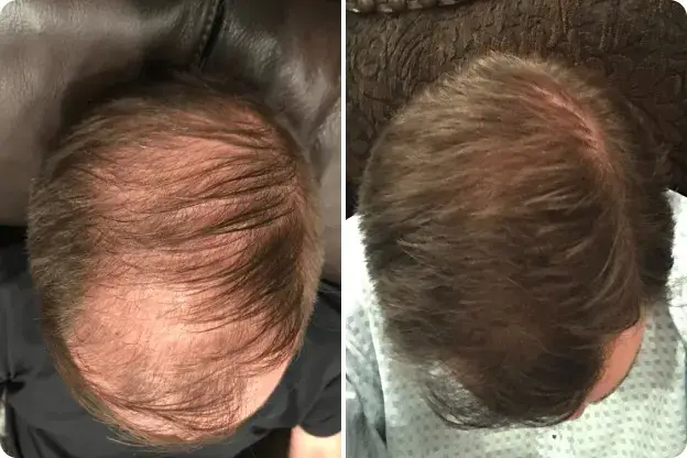 Men have been sharing their before and after progress (HIMS)