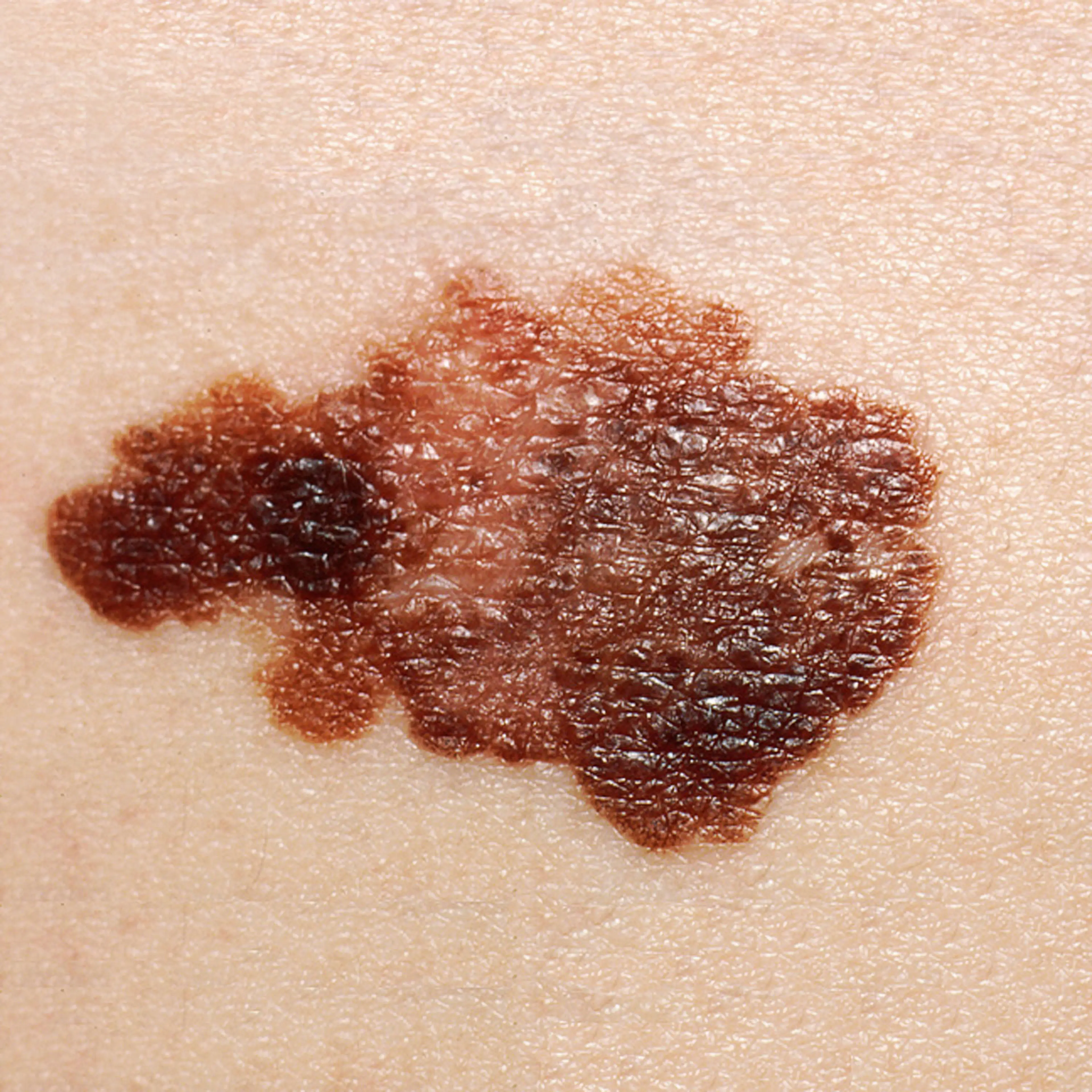 Melanomas can be detected using the ABCDE checklist (Getty Stock Image)
