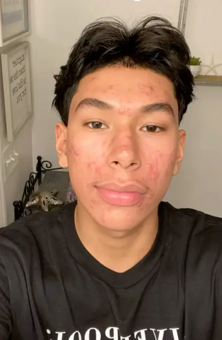 Smoking weed had a detrimental effect on his skin (YouTube/Patrick Merino)