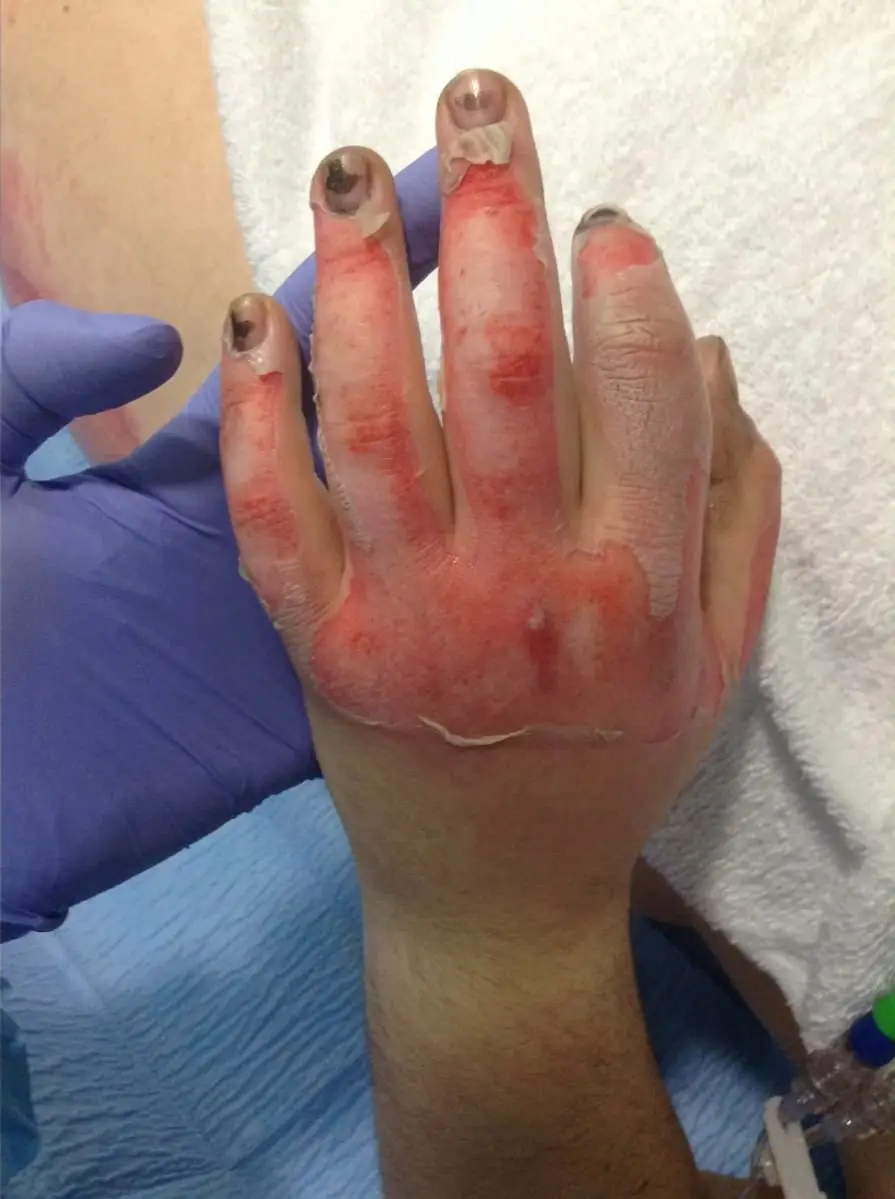Rebecca had skin grafts (Rebecca Hay)