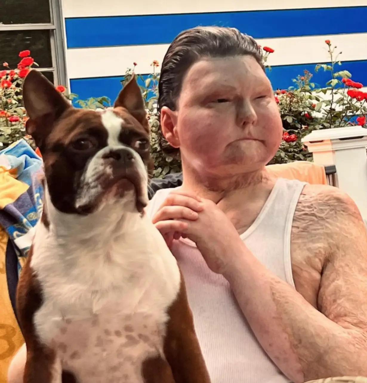 Joe received the world's first face transplant after a car crash left him with third-degree burns across 80 per cent of his body.