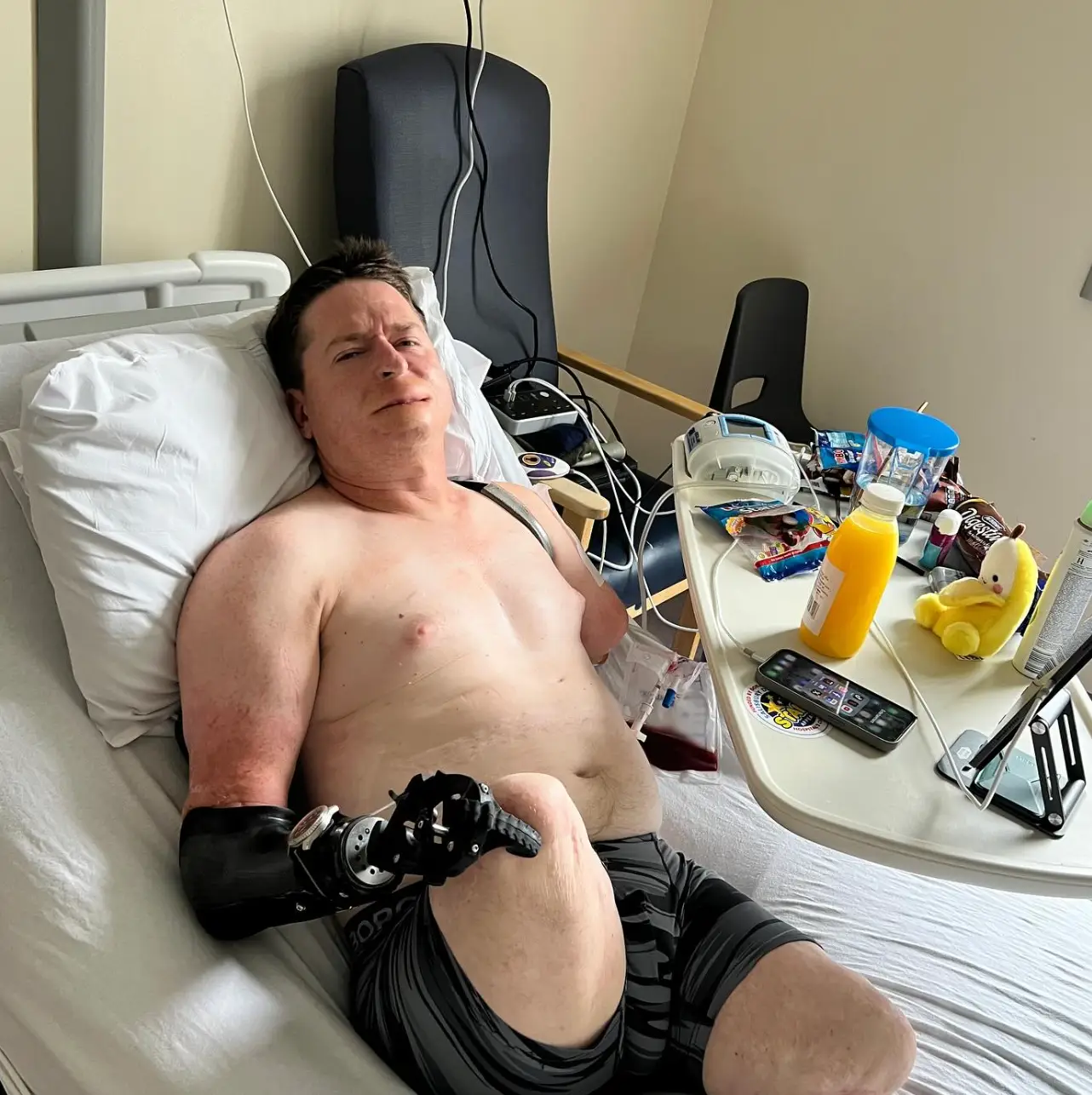 He continues to need 'regular surgical revisions' (Instagram/@alexlewisalff)