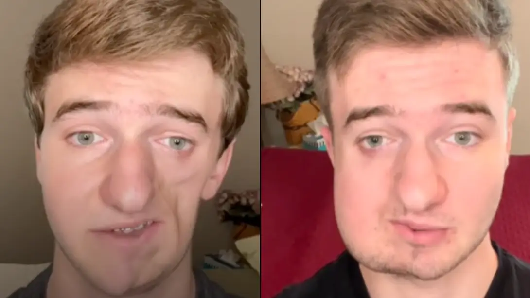 Man living with rare condition that causes one half of face to shrink shares 'hardest part' about dealing with it