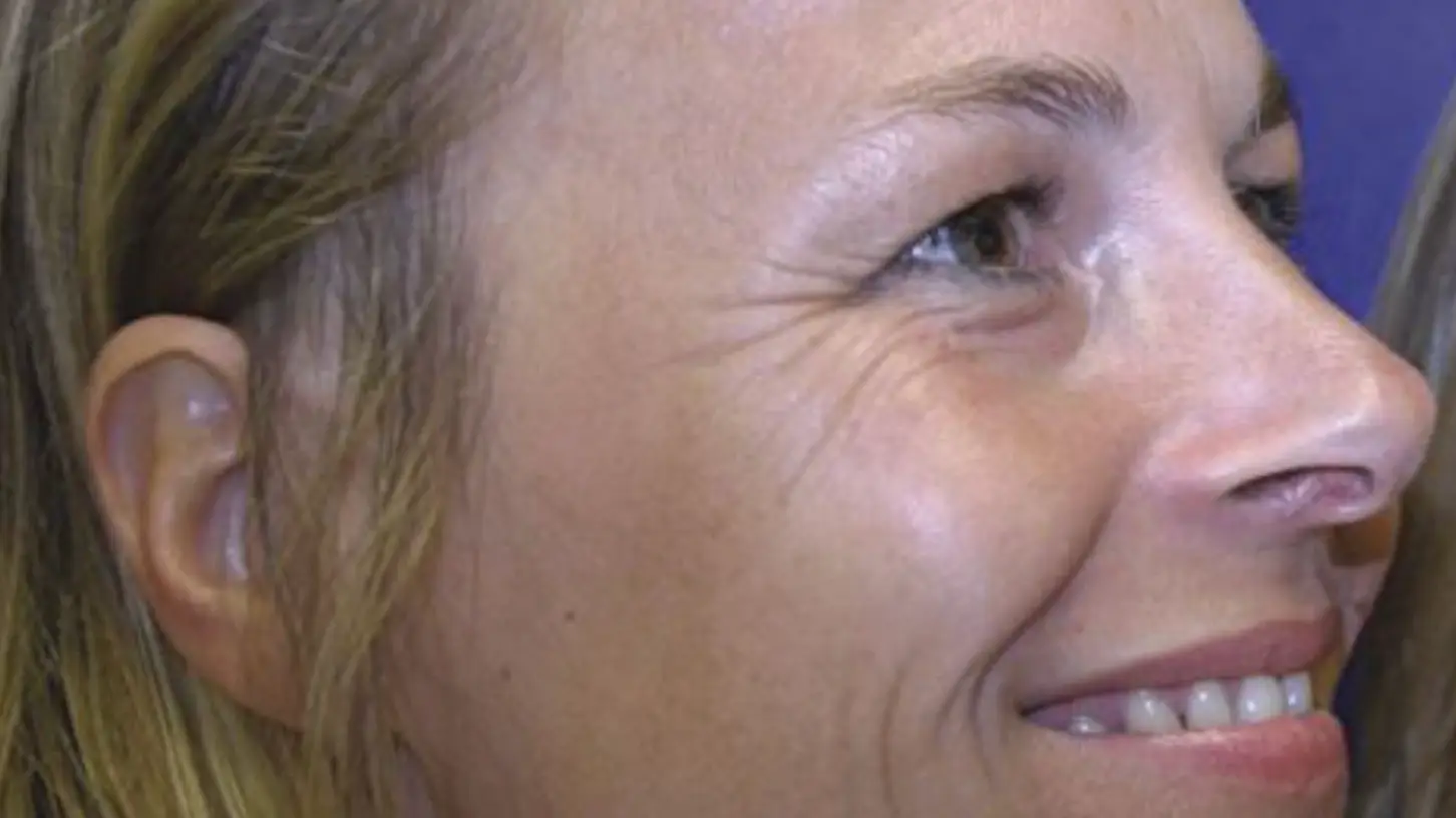 Identical twins show off difference in faces after only one used botox for 20 years