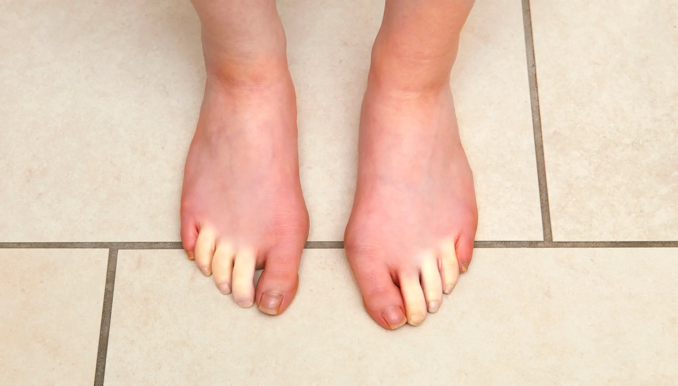 Symptoms can be present in the fingers and toes (Getty Stock Images)