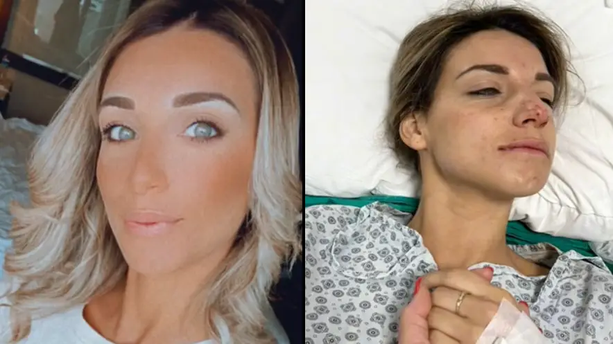 Woman Shares Horror ‘Turkey Teeth’ Experience Which Required Serious Treatment When She Returned To UK