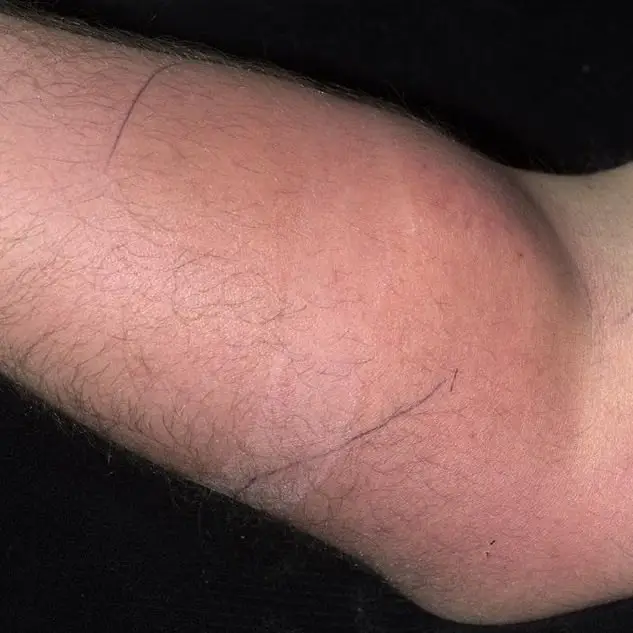 He was immediately admitted to hospital and given anti microbial treatmet (X/IMJ)