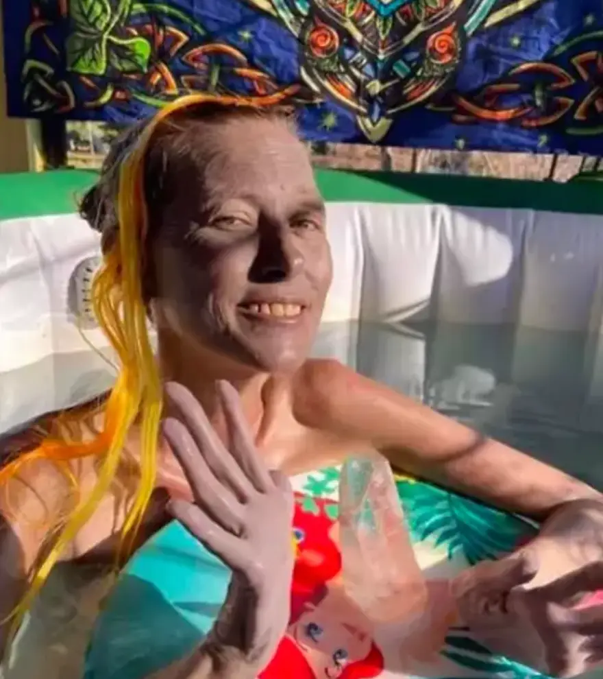 Carlson's body began to change colour (HBO)