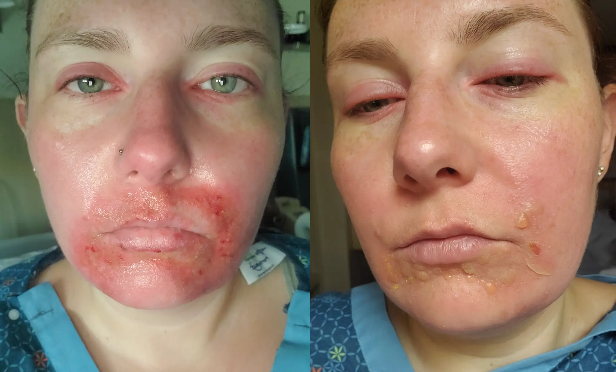 Even a few minutes in the sun can land her in hospital (Supplied/Emily Richardson)