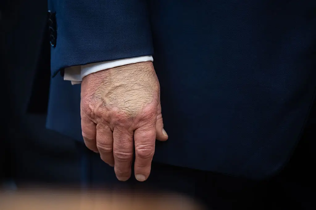 Trump's swollen hands made headlines earlier this year, sparking concern (Francis Chung/Politico/Bloomberg via Getty Images)