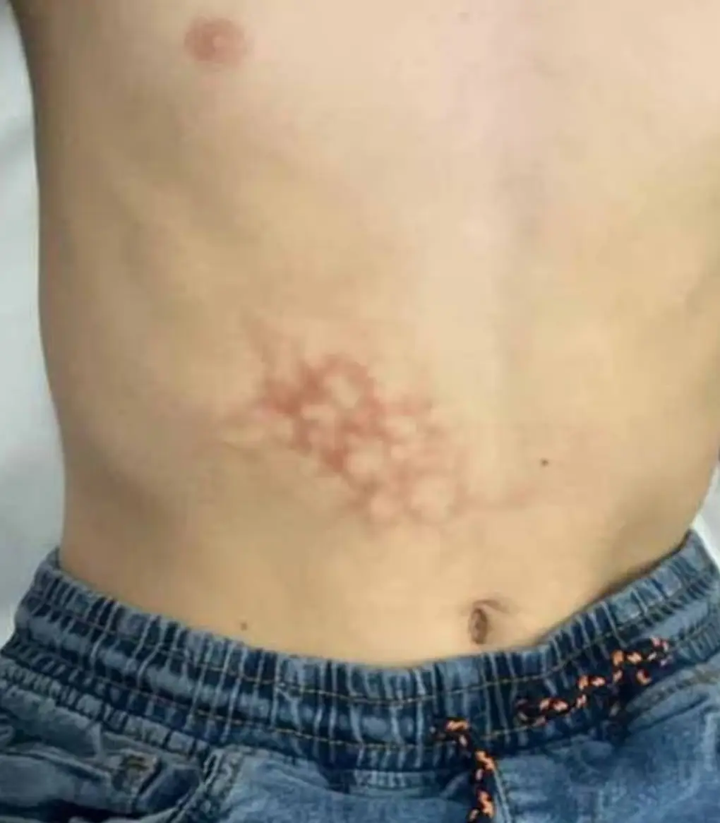 The young British boy had a 'benign' case of toasted skin syndrome in the end (Znagoveanu and Artley)