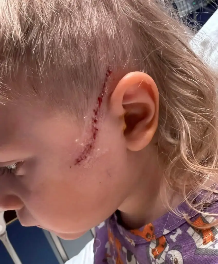 The three-year-old sustained a wound to his face and to his hand (Facebook/Sara Hillman)