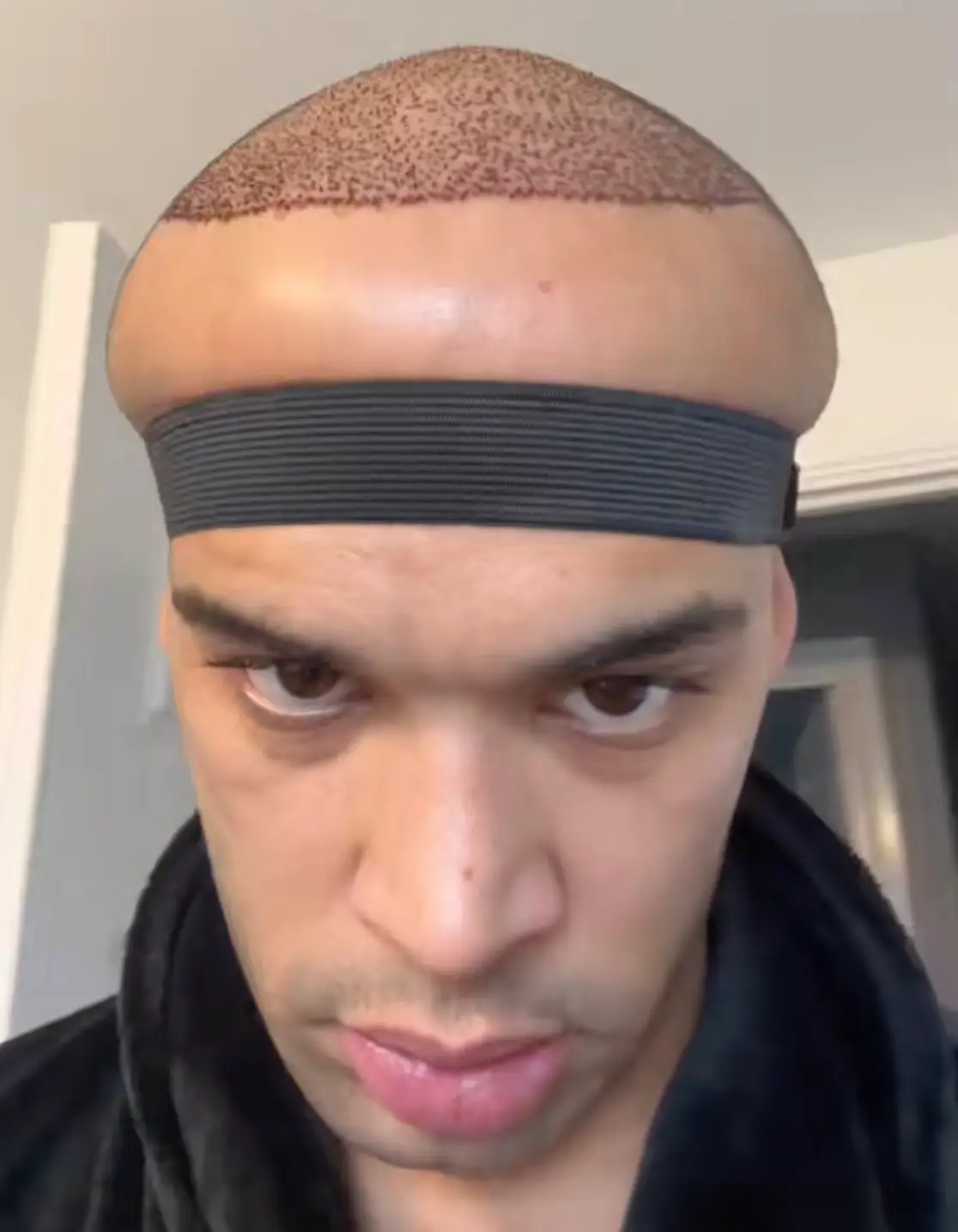 Kanah's head exploded in size after he had a hair transplant (TikTok/@kanahflextv)