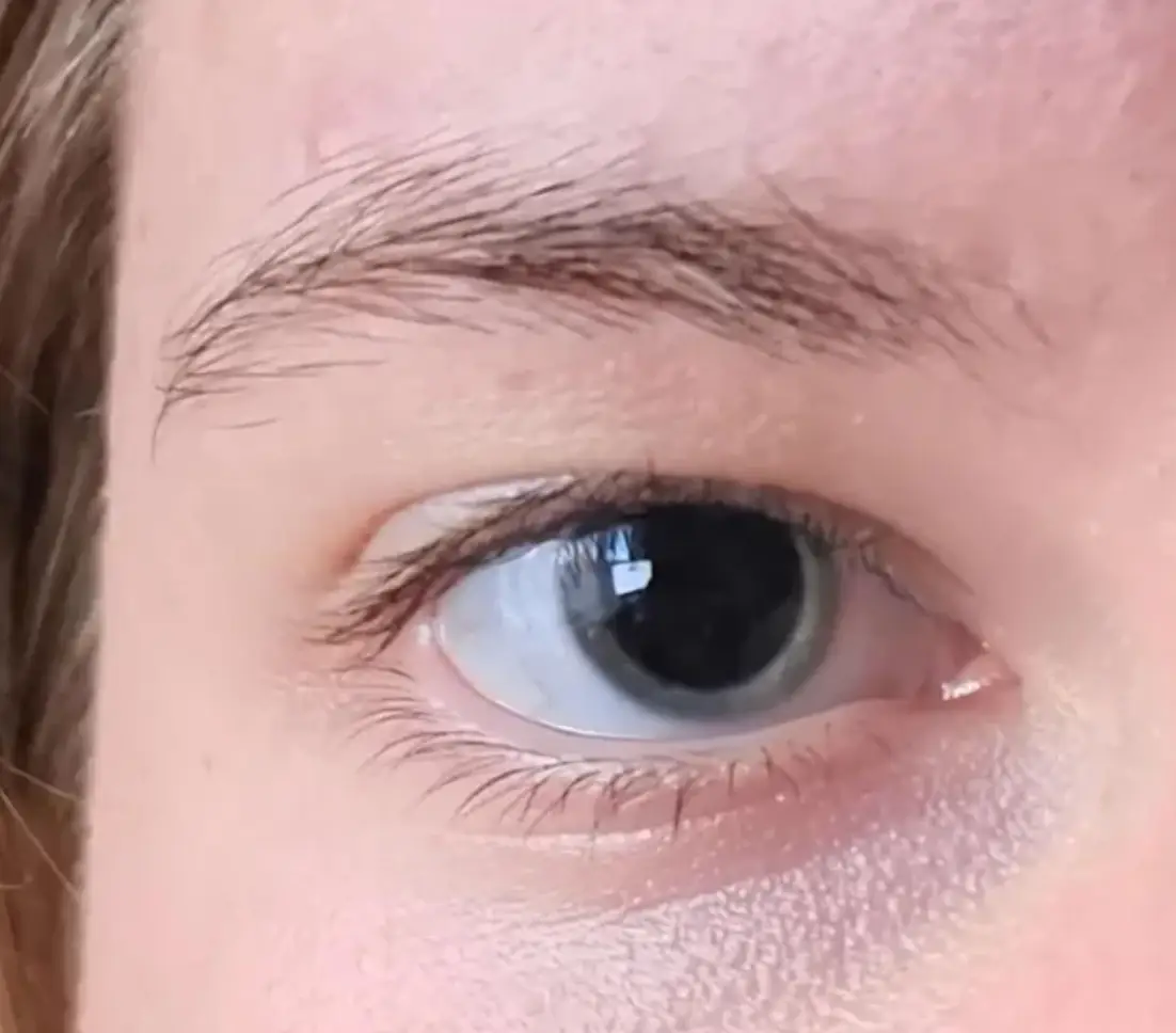 She was alarmed over how dilated her pupils had become (Reddit)