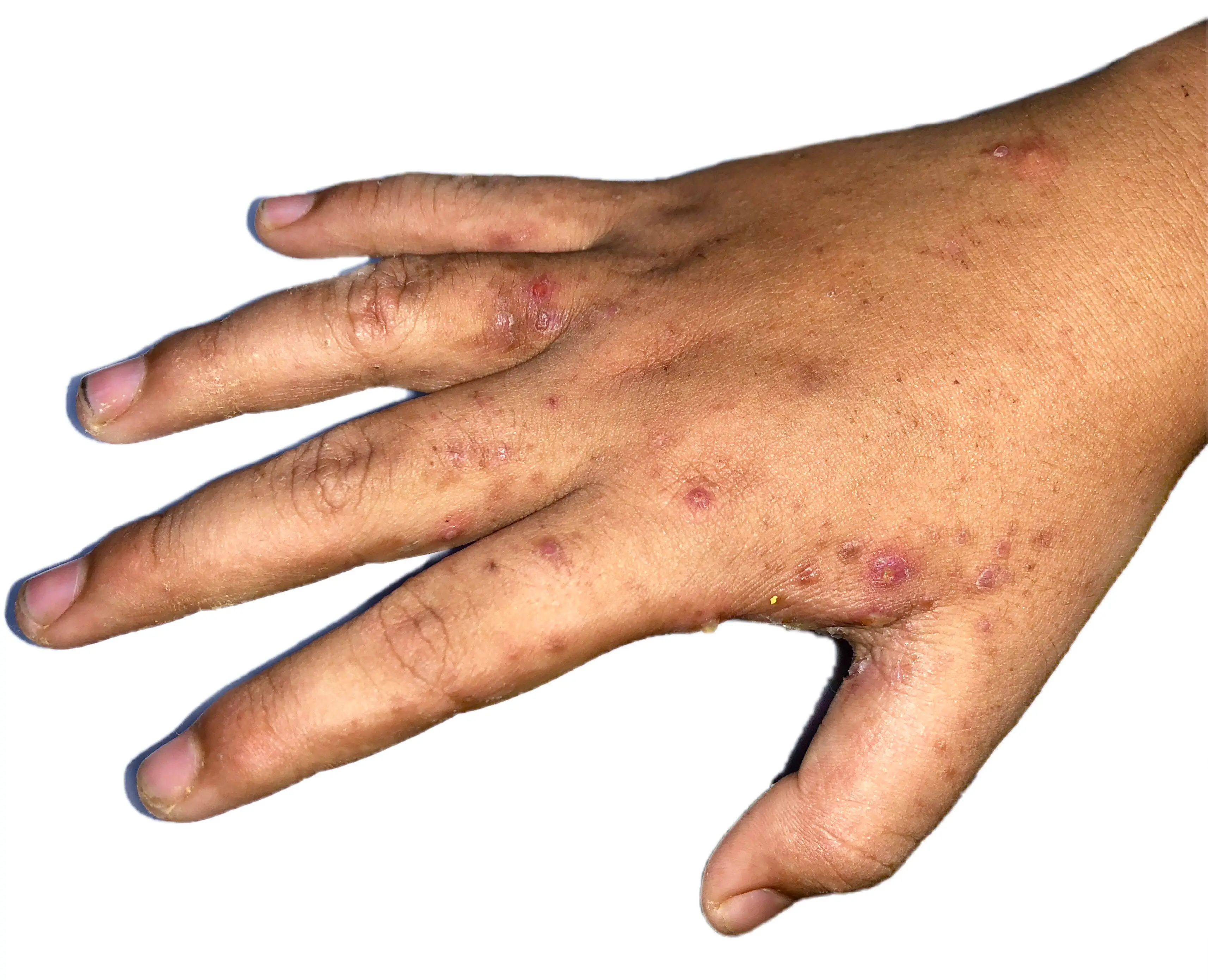 A child with scabies (Getty Stock Images)
