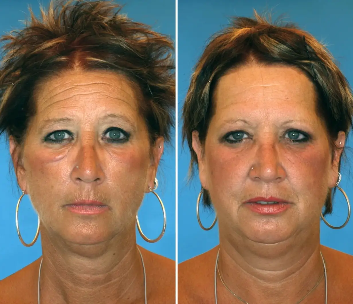 Brenda and Barb, aged 52 (NBC)
