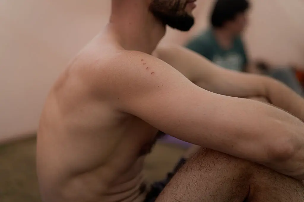 Rituals involving kambo make burn marks on the body then apply the poisonous substance, experts have warned there are no proven health benefits (Amadeusz Swierk/SOPA Images/LightRocket via Getty Images)