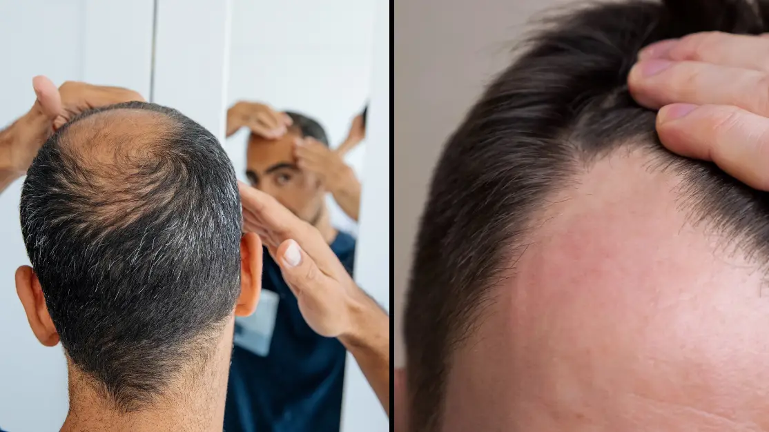 Groundbreaking treatment could stop people going bald in their 20s