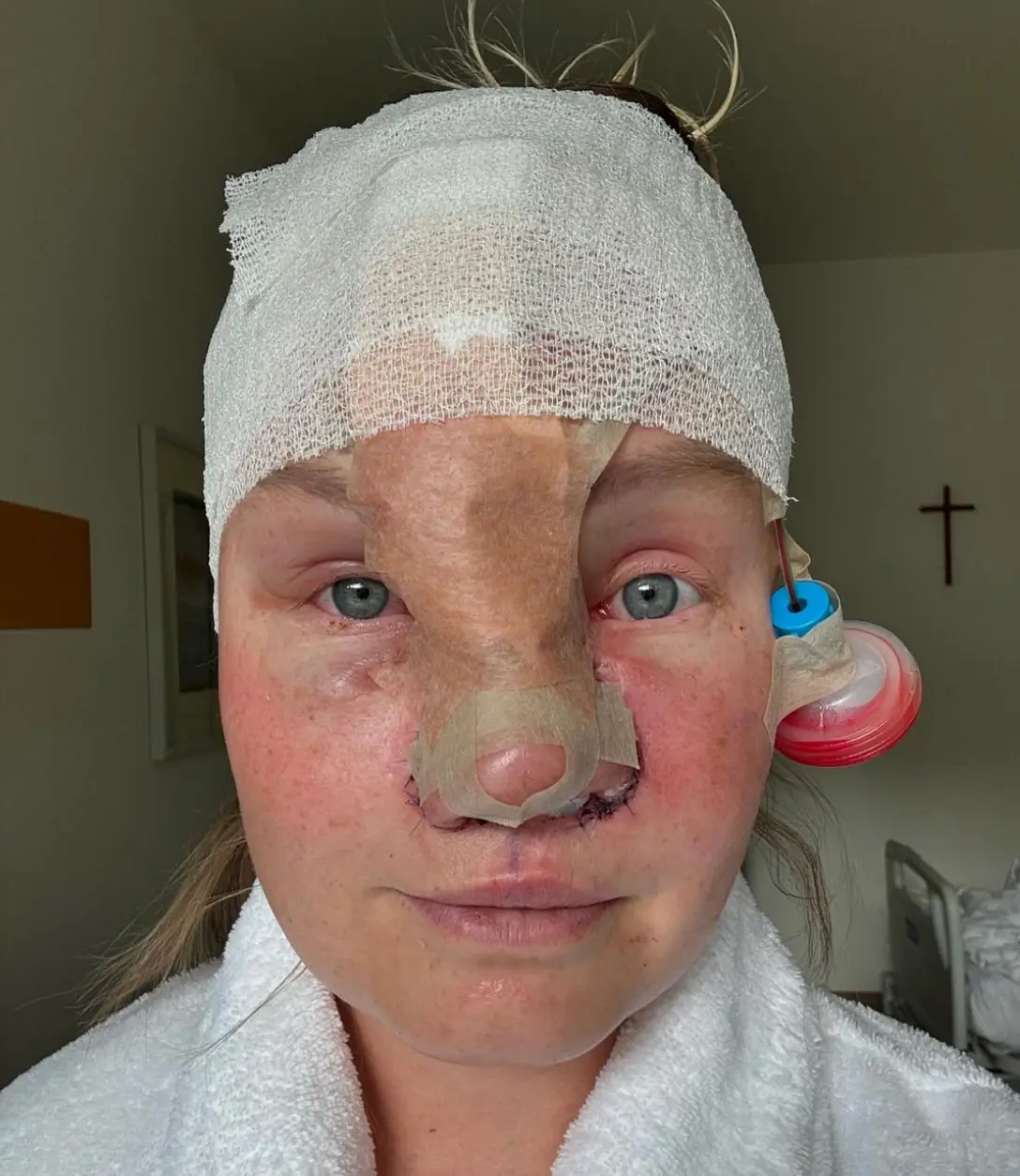 Charlotta is undergoing a nose reconstruction (Instagram/@charmlottan)