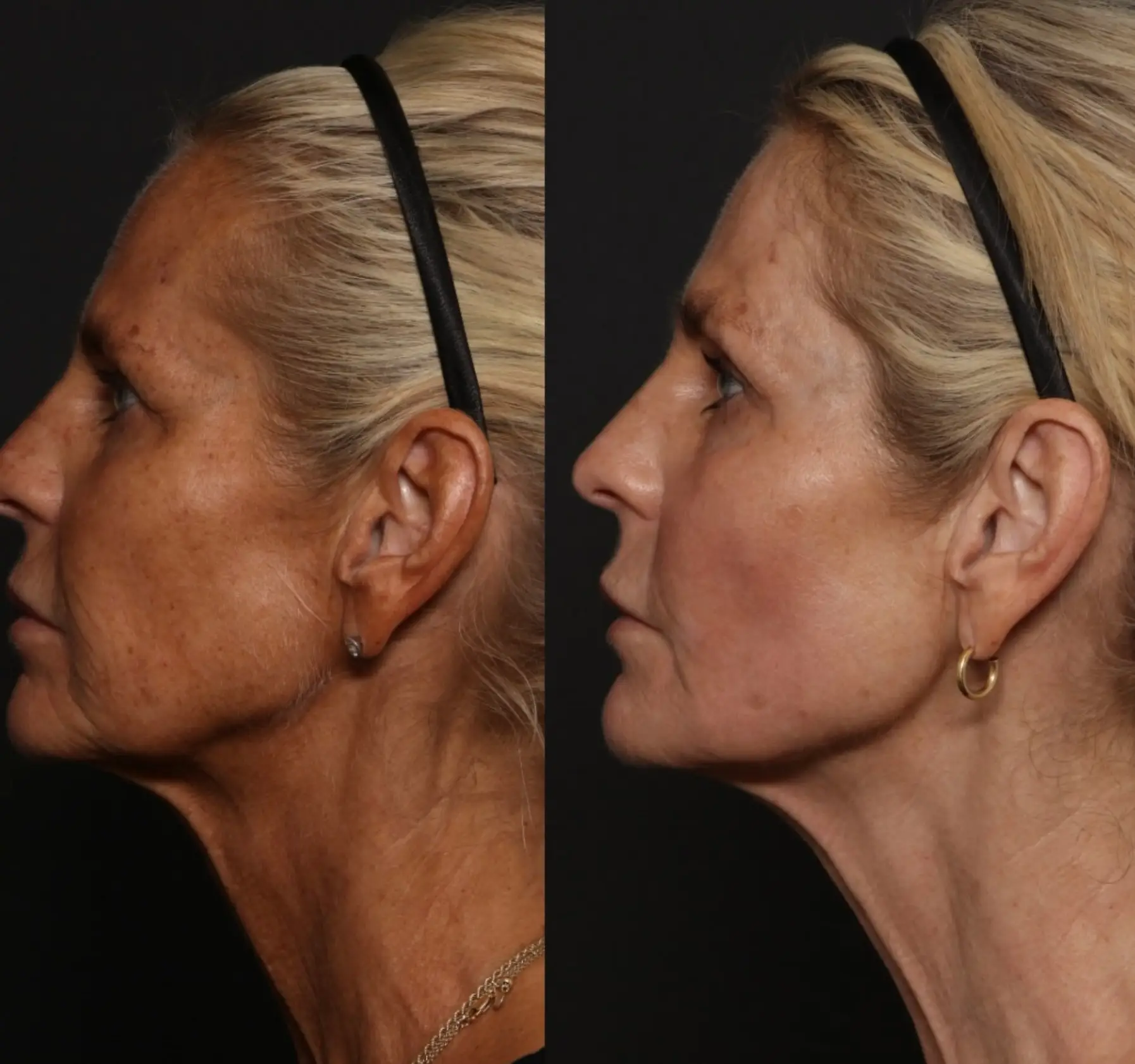 The mother-of-four is over the moon with her results (Instagram/@defineclinic)