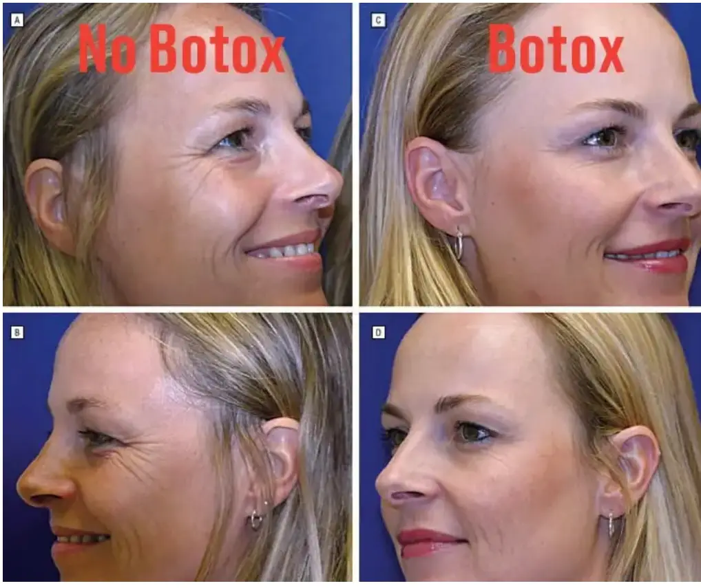 One sister swerved regular Botox injections, while the other kept up with them (American Society for Dermatologic Surgery)