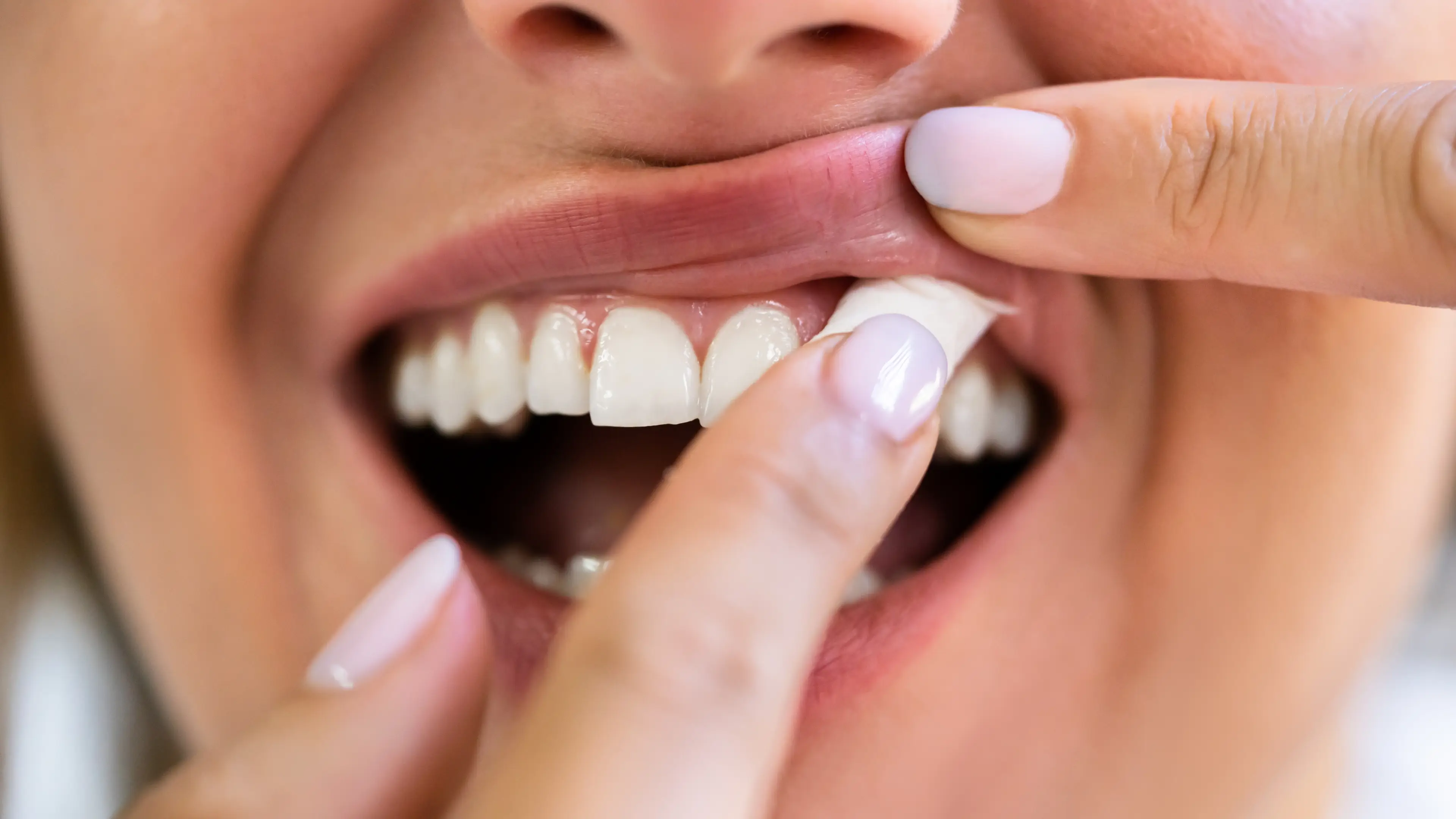Doctor shows horrifying impact on gums from using snus and chewing tobacco