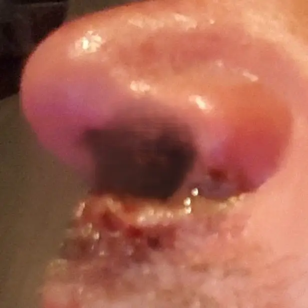Higgins said blowing his nose would see bits of 'flesh' come off his nose (MEN Media)