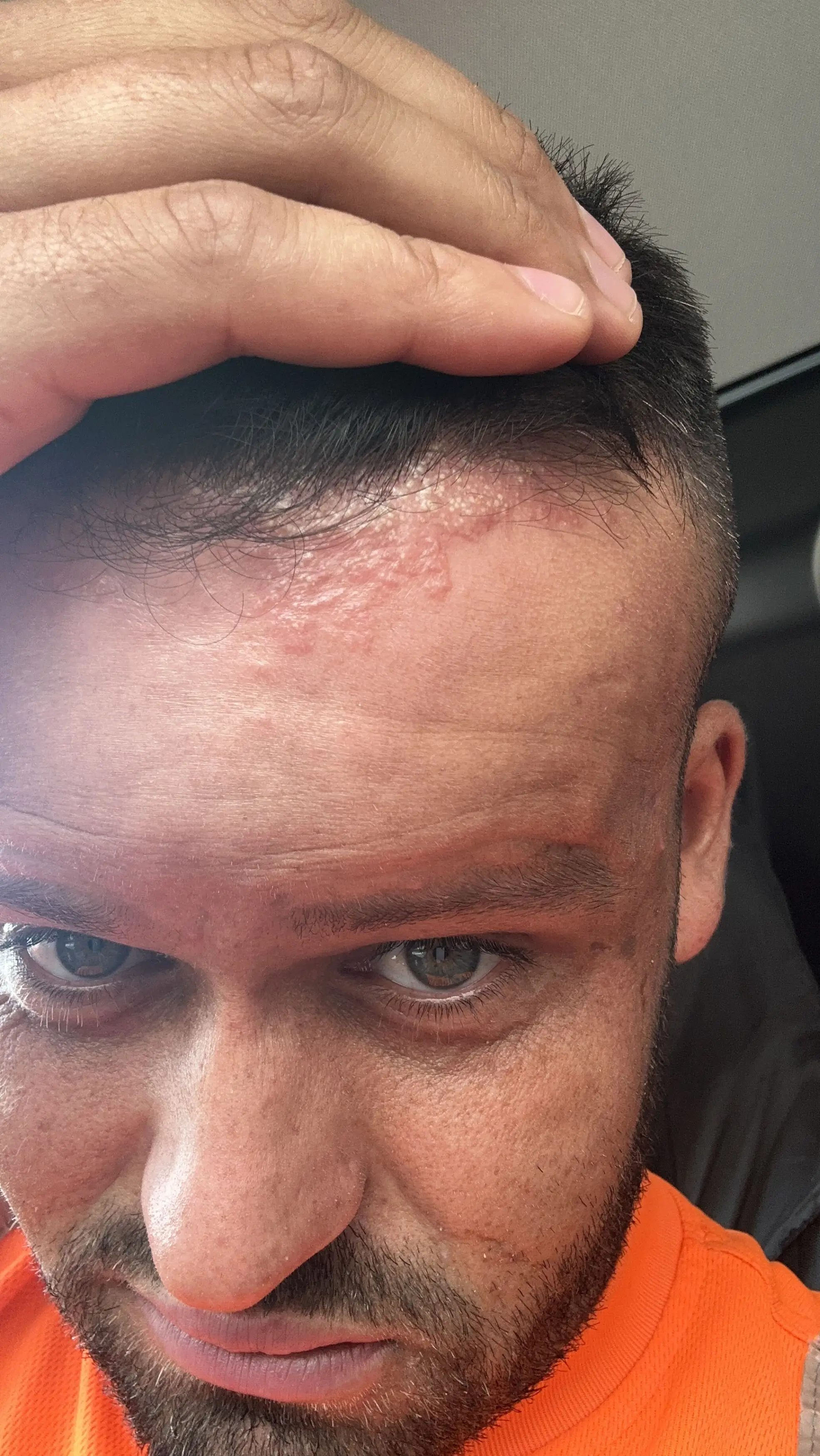 Ryan Briggs noticed a rash along his hair line (Kennedy News and Media)