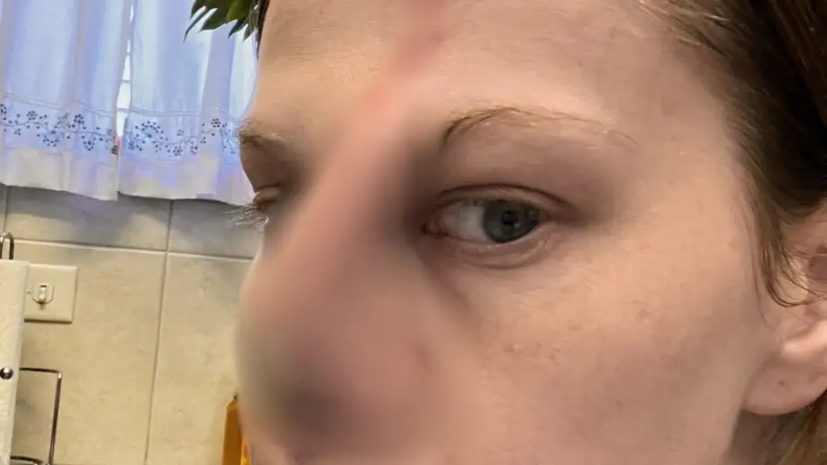 Woman left with ‘gaping hole’ in her face after ‘doing too much cocaine’ issues serious warning to others