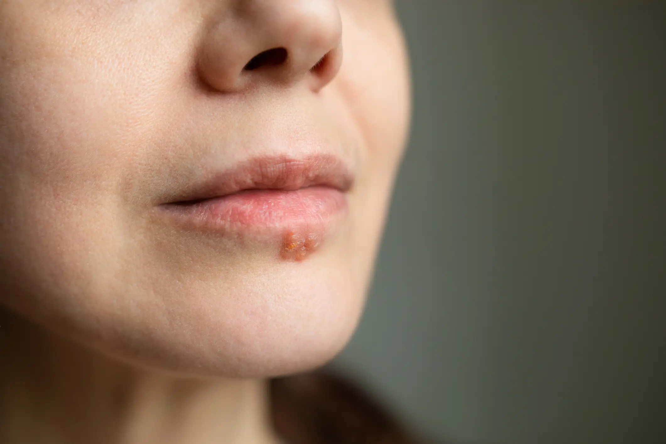 Meanwhile herpes will appear as painful bumps (Getty Stock Images)