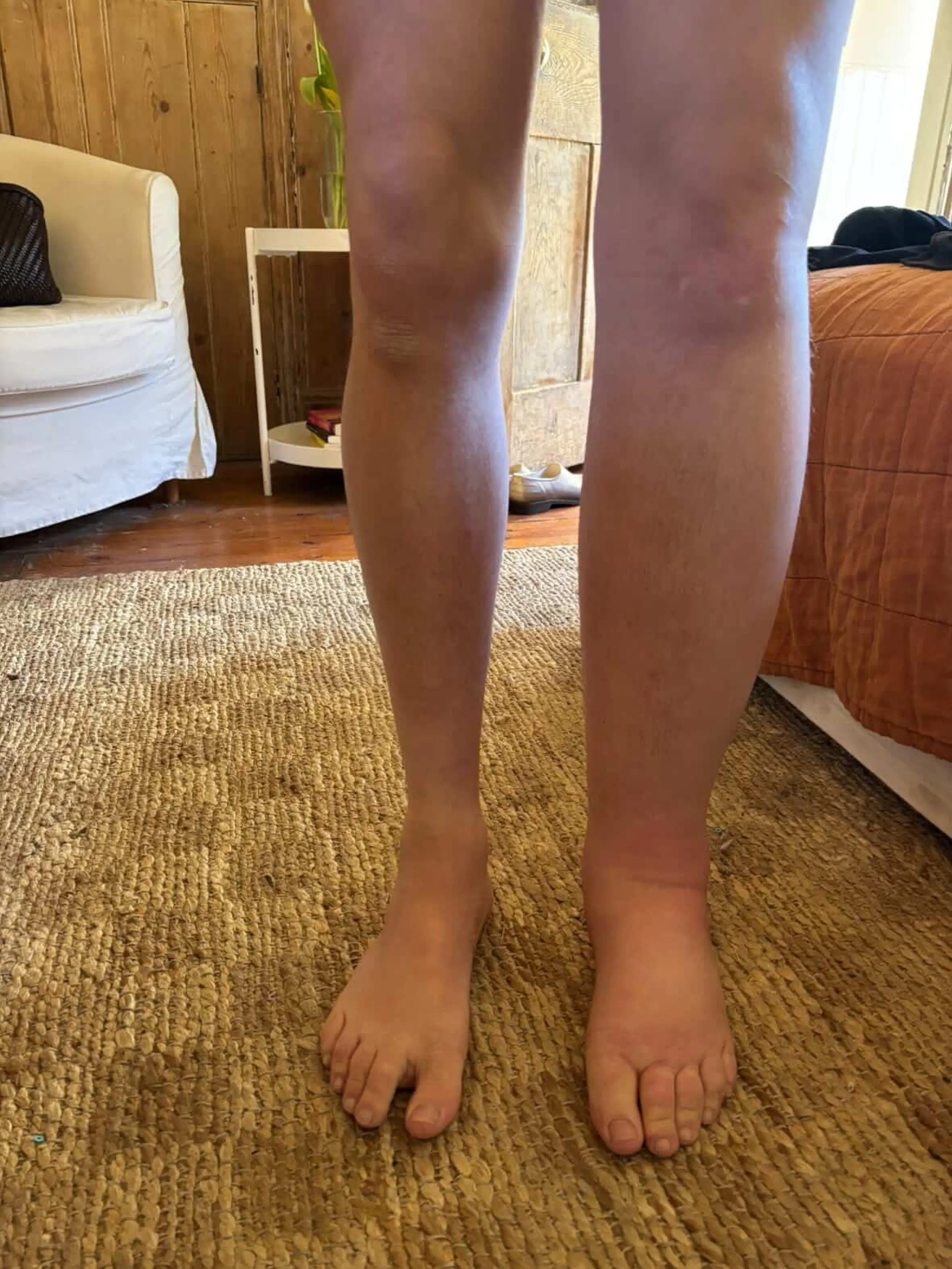 His left leg is now bigger than his right (Kennedy News and Media)